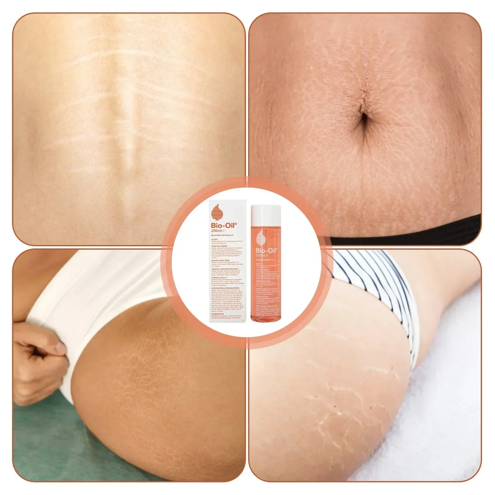 Bio-oil 200ml, Prevents and Fades Pregnancy Obesity Scars, Is Gentle and Non-irritating.